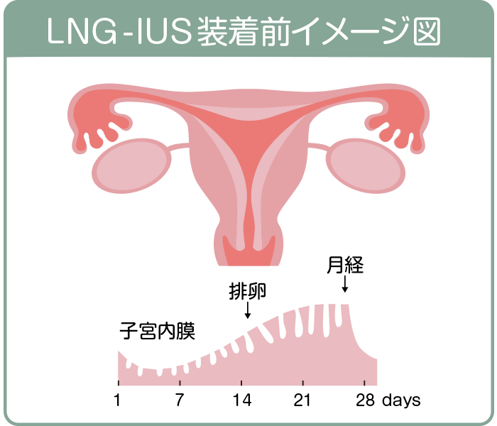 LNG-IUS装着前イメージ図