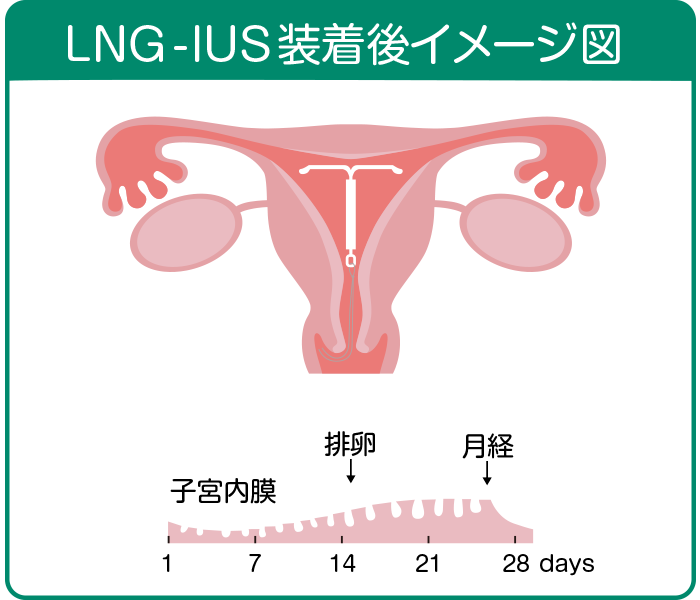 LNG-IUS装着後イメージ図