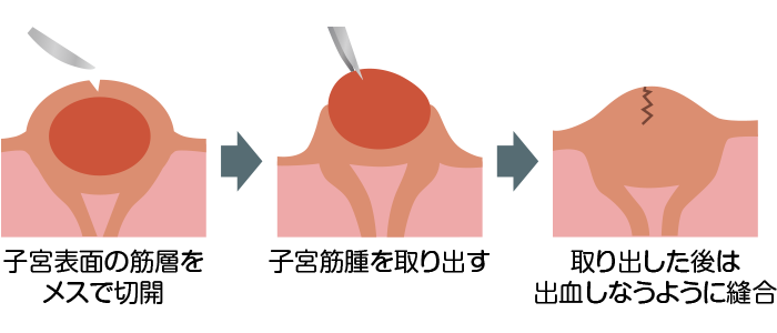 子宮筋腫核出術