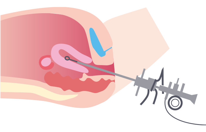 子宮鏡下手術
