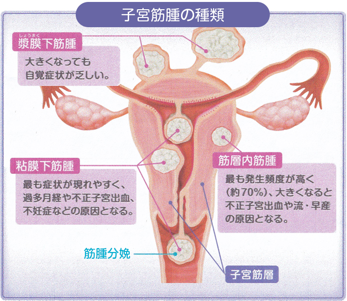 横からみた子宮筋腫