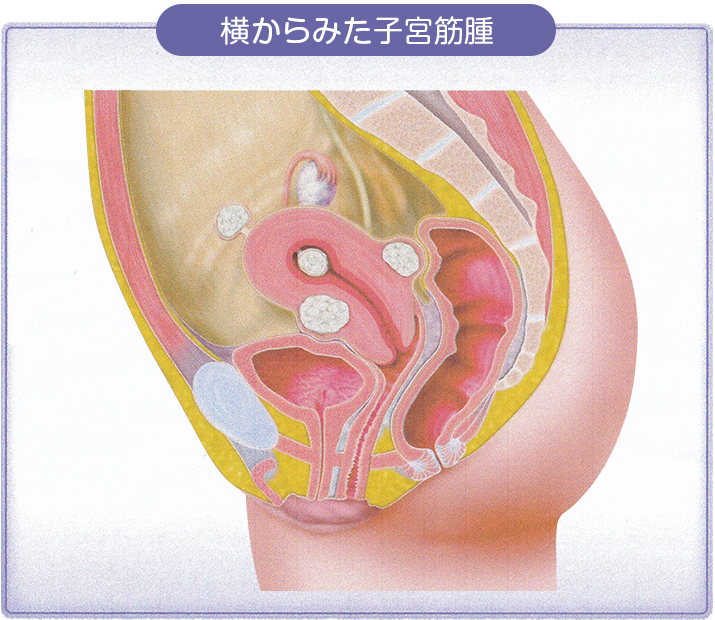 横からみた子宮筋腫