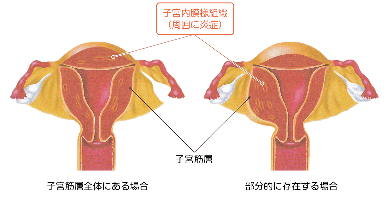 子宮腺筋症